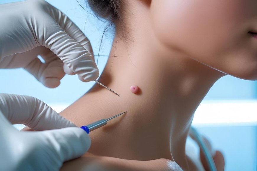 Skin Tag Removal at Urgent Care: What to Expect & Why It’s a Smart Choice